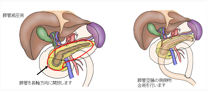 膵管減圧術