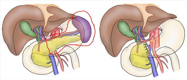 膵体尾部切除術切除術について