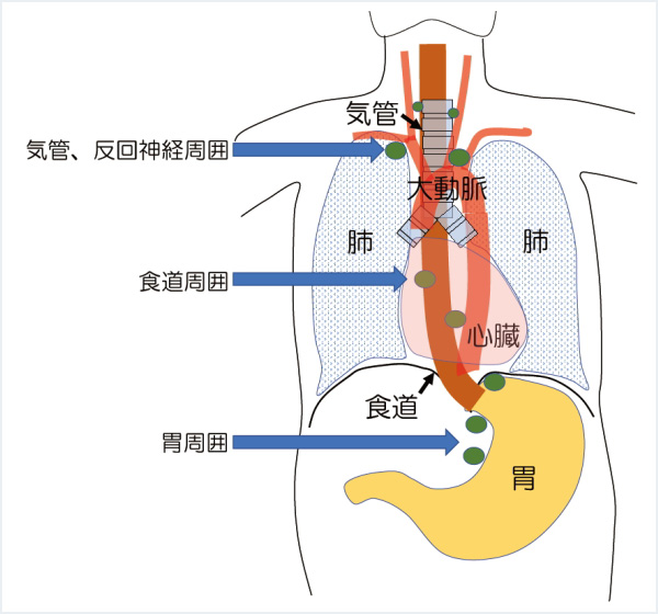 図2：食道がんの転移しやすいリンパ節