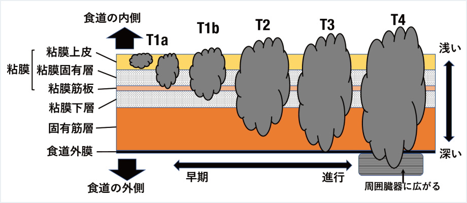 図3：腫瘍の深さの分類（T因子）