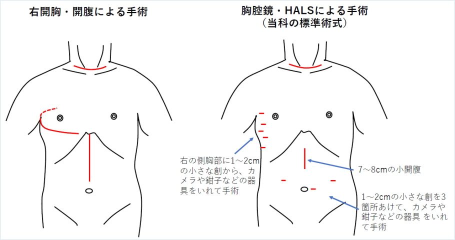 図10：食道癌手術の創部