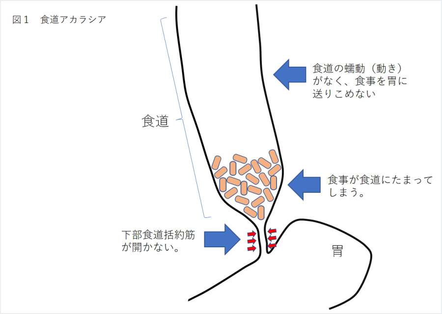 食道アカラシア