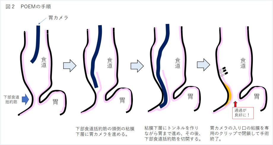 POEM（経口内視鏡的筋層切開術）