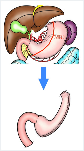 腹腔鏡下スリーブ状胃切除術