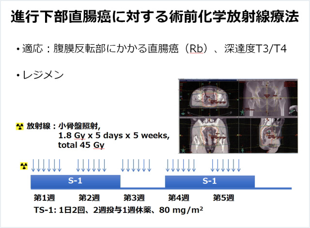 4. 術前化学放射線療法を組み合わせた集学的治療