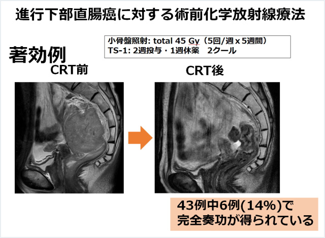 4. 術前化学放射線療法を組み合わせた集学的治療