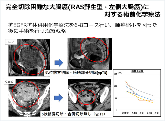 5. 局所進行例、遠隔転移例、局所再発例に対する集学的治療