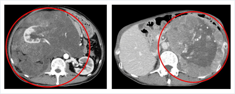 後腹膜腫瘍（左：脂肪肉腫、右：副腎腫瘍）
