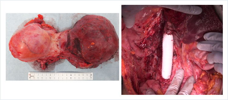 血管合併切除症例（左：腫瘍（右腎、下大静脈合併切除）、右：下大静脈再建後）