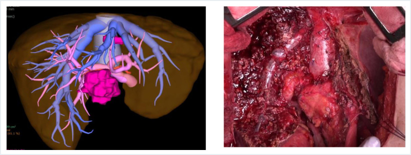 大腸癌肝転移に対する中央二区域切除＋尾状葉切除