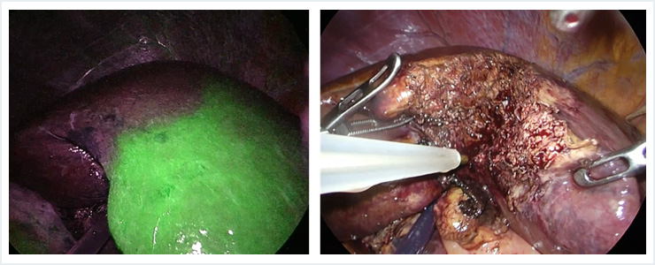 肝細胞癌に対する腹腔鏡下右肝切除とICG蛍光法