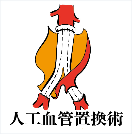 人工血管置換術