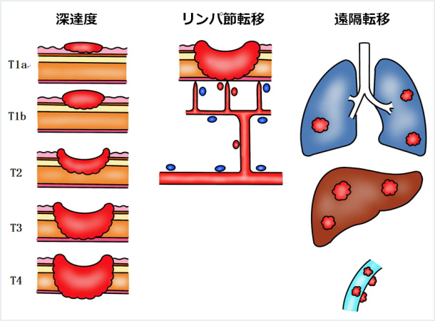 病期（ステージ）