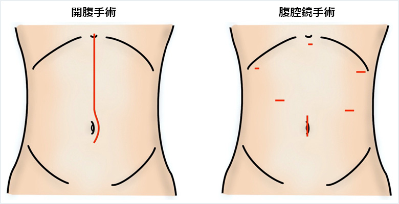 開腹手術と腹腔鏡手術