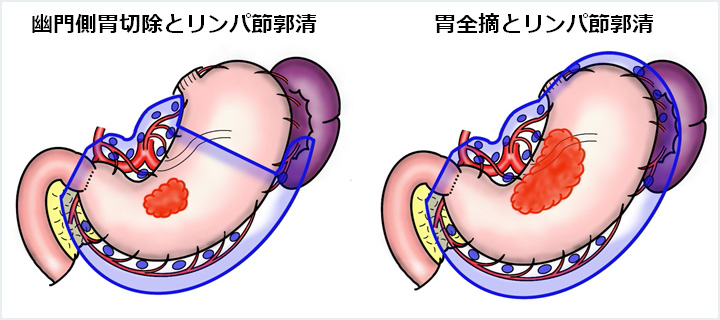 幽門側胃切除とリンパ節郭清　胃全摘ととリンパ節郭清