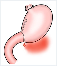 術中出血、術後出血