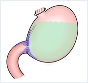 吻合部狭窄、潰瘍、通過障害