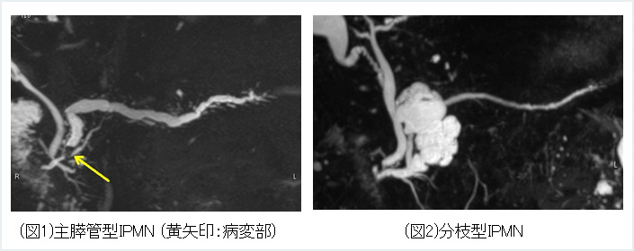 膵管内乳頭粘液性腫瘍(IPMN)