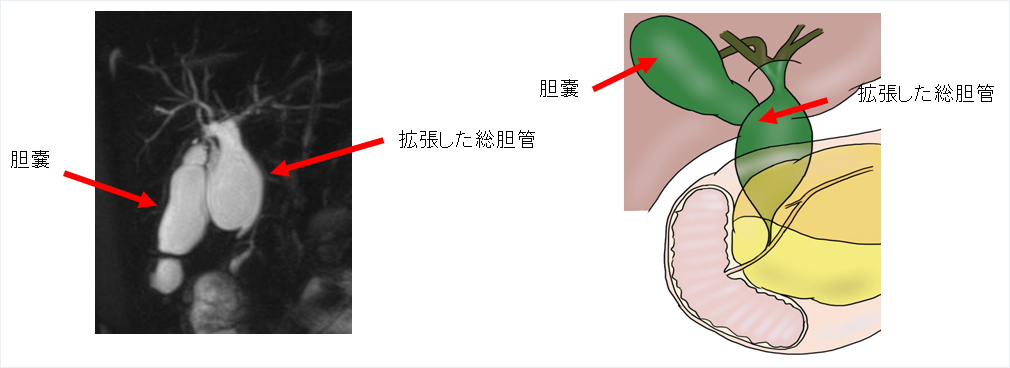図：先天性胆道拡張症，膵・胆管合流異常の胆管像