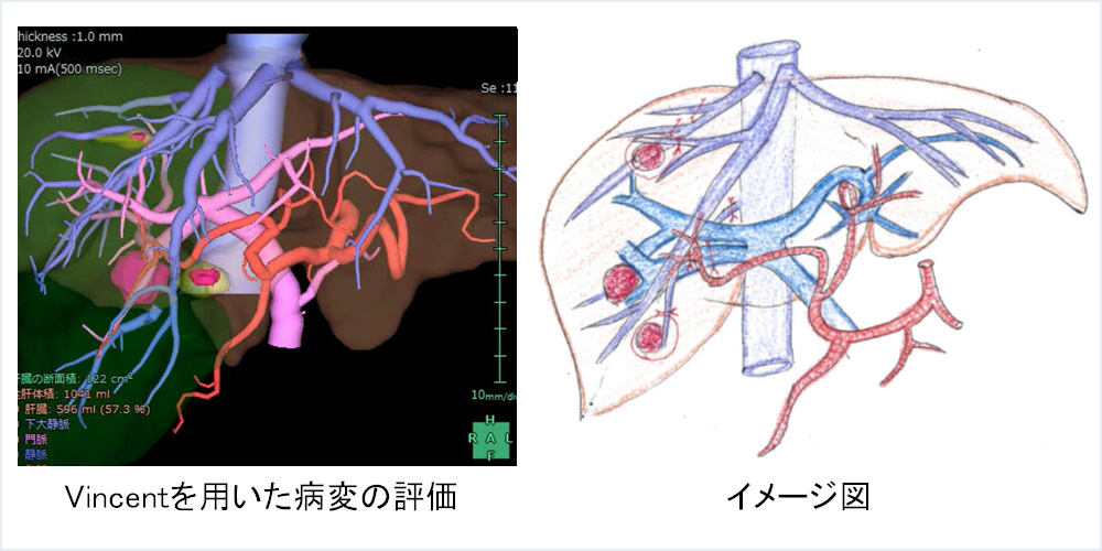 Vincentを用いた病変の評価・イメージ図
