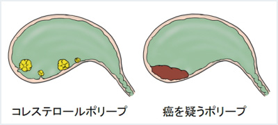 胆嚢ポリープ