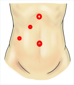 腹腔鏡下手術の傷部