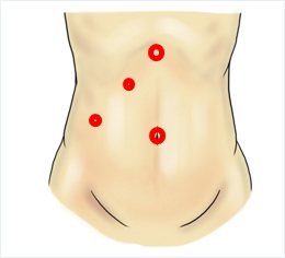 腹腔鏡下胆嚢摘出術の傷部